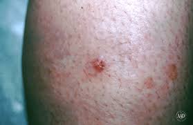 Image result for Merkel Cell Carcinoma