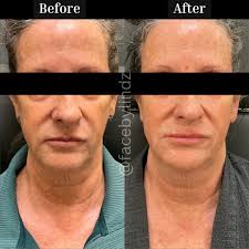 ✨ Agnes RF + Scarlet SRF = The Ultimate Skin Tightening Duo ✨** This  transformation speaks for itself! With a customized combination of **Agnes  RF** and **Scarlet SRF**, we've been able to **
