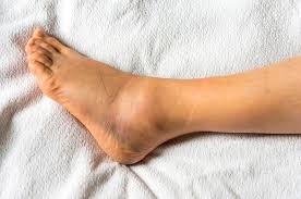 Tulang kaki yang membengkak karena kekurangan vitamin. Kaki Bengkak Akibat Diabetes Perlu Diatasi Begini 5 Solusinya Semua Halaman Grid Health