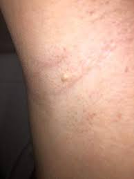 Was Ist Das Fur Ein Pickel Unter Mein Arm Gesundheit Und Medizin Gesundheit Haut
