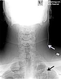 Fractured Vp Shunt Frontal Radiograph Of The Cervical Spine Edge Enhanced Shows A Fracture Of The Ventriculo Peritoneal Shunt Dr Vp Shunt Pet Ct Radiography