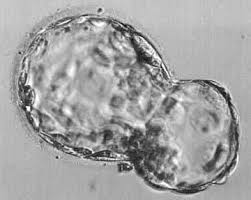 Day 5 Blastocyst Transfer With Ivf Can Reduce Multiple Pregnancy Risks