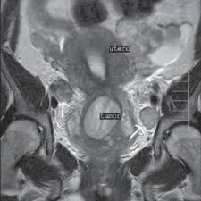 Encuentra un especialista en tu ciudad Coronal T2 Tse Mostrando Tumor De Colo Uterino E Linfonodos Aumentados Download Scientific Diagram