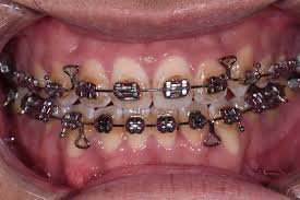 Don't try this at home. Ems Air Flow Stain Removal Around Braces