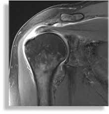 Was ist eine magnetresonanztomographie (mrt)? Rotatorenmanschettenruptur Orthopaedicum Frankfurt