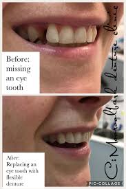 People also asked, how much does flexible dentures cost? Flexible Dentures Denture Clinic Melbourne