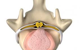 Livmoren vil da sige ned og i uttalte tilfeller kunne stikke ut av skjeden. Livmorfremfall Livmorprolaps Altomhelse No Kunnskap Trygghet Nysgjerrighet Gjennom Hele Livet