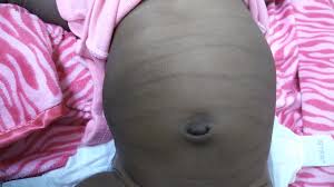 Cut down on your caloric intake. Transient Pigmentary Lines Of The Newborn Pediatrics