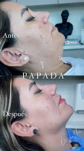 #medicina estética: Define tu contorno mandibular con lo último en  tecnología Endolifting y Lipolaser, con este procedimiento logramos definir  tu contorno mandibular, mejorar flacidez de Mejias y ...