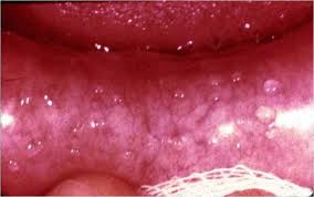 Pimples in the mouth can appear as bumps, sores or lesions. Bump On Roof Of Mouth Possible Causes And Medical Suggestions