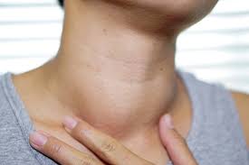 Radioiodine Therapy For Hyperthyroidism Presents No Longterm Cancer Risk