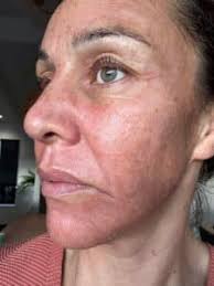 Watch Jessie During Her Cosmelan Journey