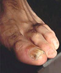 Dermatologie Diabetes Zeichnet Die Haut Pz Pharmazeutische Zeitung