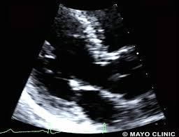 Image result for Exercise Induced Syncope