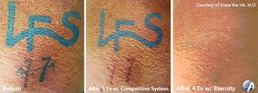 Maybe you would like to learn more about one of these? Laser Tattoo Removal In San Antonio Texas Astanza Laser