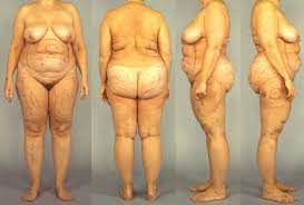 Patient With Dercum S Disease The Patient Has Type I Dercum S Disease Download Scientific Diagram