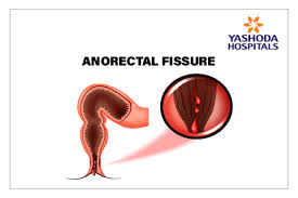 The acute management of haemorrhoids. Laser Proctology Treatment For Piles