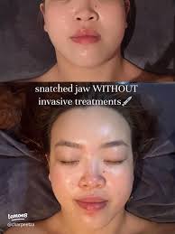 Flatten cystic acne in just 3 days! JB Clinic~
