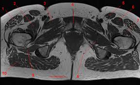 The abdominal muscles contract very powerfully, fig. Mri Of The Hip Detailed Anatomy W Radiology