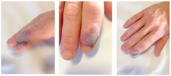 An unusual finger injury | The BMJ