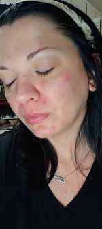 It's that time of year that my dry skin drives me crazy. What do others do  for it besides all the normal cocoa butter, over the counter stuff?