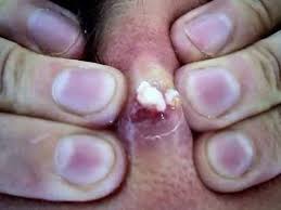 This Is What Popping A 20 Year Old Zit Looks Like Zits Popping Pimple Popping Zits