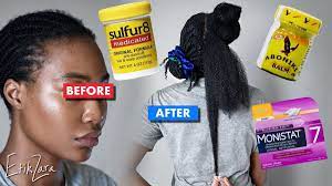 Before using monistat for hair growth, you ought to consult a dermatologist. Zazamia Pa Twitter New Vid Finally Showing Y All How I Mix My Special Sulfur 8 For Crazy Hair Growth And Incredible Scalp Relief Check It Out Https T Co Mwpa3suu5m Retweet Https T Co 5kxw6rqdxc
