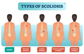 Vertebrologists advise avoiding strong overstrain of the muscles of the back and arms and recommend a style such. Scoliosis Symptoms