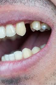 What To Do If A Tooth Is Knocked Out What To Do If A Tooth Is Knocked Out