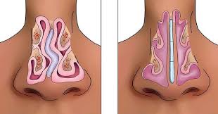 The nasal septum is made from bone and cartilage, and it helps with airflow in the nasal passages. Surgery Of The Nasal Septum Septoplasty Atlas General Hospital