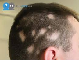 Tip Lisaninda Alopesi Areata Denilen Sackiran Illeti Yakalanan Kisinin Sac Kirpik Ya Da Kaslarinin Bir Kisminin Kellesmesine Deniliyor Sac Biyiklar Kirpik