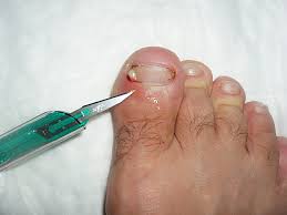 Image result for Paronychia feet
