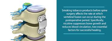 Tips To Quit Smoking Before Spinal Fusion Surgery Olss