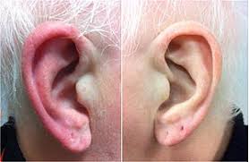 Red Ear Syndrome Wikipedia