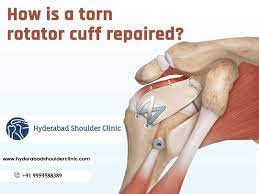 The most common surgery to fix a rotator cuff impingement is called a subacromial decompression (sad). How Is A Torn Rotator Cuff Repaired
