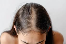 Estrés y caída del cabello: ¿cómo afecta y qué puedes hacer para evitarlo?  - Rueber Centro Capilar