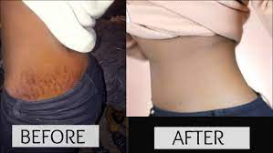 The Best Way To Get Rid Of Dark Stretch Marks Avoidstretchmarks Stretch Marks Stretch Mark Remedies Homemade Wrinkle Cream