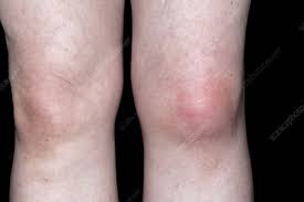 Image result for gout symptoms knee