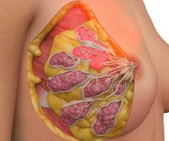 Image result for Mastitis