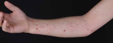 Image result for Eczema nummulare
