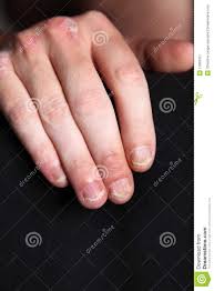 Learn vocabulary, terms and more with flashcards, games and other study tools. Psoriase Das Unhas U Hand Imagem De Stock Imagem De Queimadura 17663151