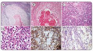 Recessed lighting installation necrotizing granulomatous inflammation. Scielo Brasil Diagnosing Lymphoma In A Setting With A High Burden Of Infection A Pediatric Case Of Epstein Barr Virus Associated Aggressive B Cell Lymphoma With T 8 14 Q23 Q32 And Extensive Necrosis Mimicking Tuberculosis