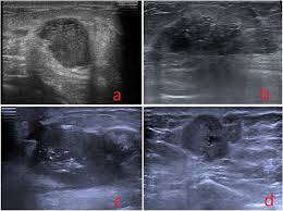 A breast ultrasound is most often done to find out if a problem found by a mammogram or physical exam of the breast may be a cyst filled with fluid or a solid tumor. Molecular Markers Pathology And Ultrasound Features Of Invasive Breast Cancer Clinical Imaging
