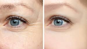 But you can see how my wrinkles aren't he didn't want me to have a frozen, expressionless face. What Is Better Botox Or Juvederm Blue Ridge Dermatology Associates Pa Blue Ridge Dermatology Associates Pa