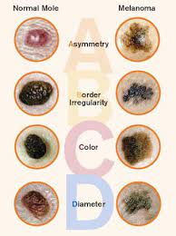 The best way to find skin cancer is to examine yourself. Pin On Essential Oils