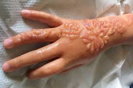 Gambar henna tangan anak kecil simple. Untuk Para Ibu Jangan Sampai Anak Gadis Anda Menderita Seperti Ini Gara Gara Henna Yang Tampak Cantik Itu Semua Halaman Intisari
