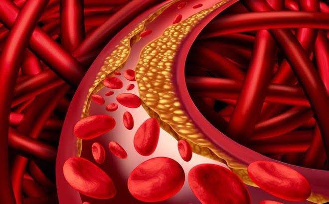 Rối loạn mỡ máu: Nguyên nhân, tác hại và cách phòng ngừa hiệu quả