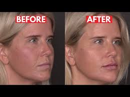 How to sculpt supermodel cheeks for your patients! (It's not JUST about  injection technique)