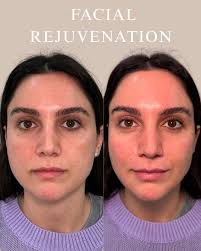ONE YEAR PROGRESS 💫 This beautiful patient initially saw us in early 2024  for Dysport (Botox) treatment to her upper face and an initial filler  treatment with 2 syringes in her chin.