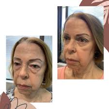Reducing lumps after blepharoplasty surgery?